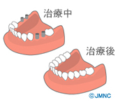 歯のチェック