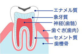 初期期むし歯